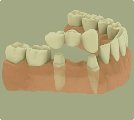 Dental Bridges | Main Street Dental Airdrie