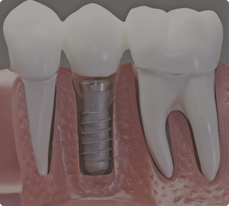 Dental Implants | Main Street Dental Airdrie
